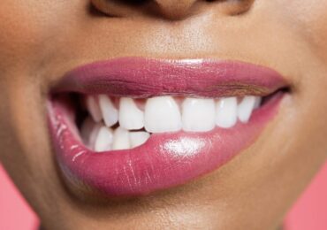 Cost-Effective Professional Tooth Whitening