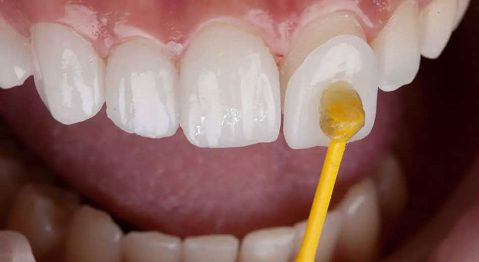 Lumineers closeup Dr. Stephen Petinge, DMD. Stephen Petinge DMD. General, Cosmetic, Restorative, Preventative, Family Dentist, Dental Implants, TMJ/TMD, Emergency Dentistry, Crowns & Bridges, Teeth Whitening, Sleep Apnea Appliances, Sedation dentistry . Dentist in Saugus, MA 01906 Top-notch dentist in Saugus, MA 01906