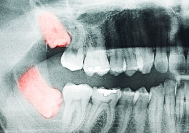 Top Reasons for Extracting Impacted or Problematic Wisdom Teeth