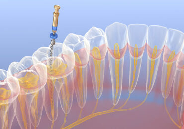 Root Canals: Answers to Your Top Questions