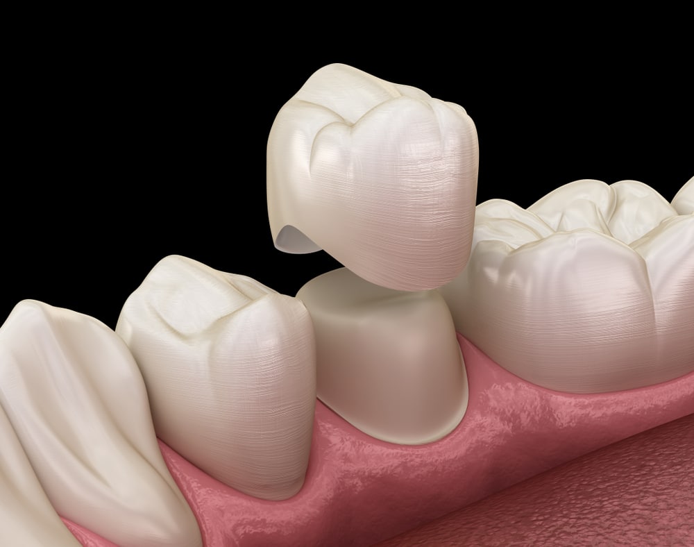 saugus dental crowns